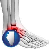 illinois a foot and ankle, showing the inflamed area in red