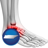 tennessee map icon and a foot and ankle, showing the inflamed area in red
