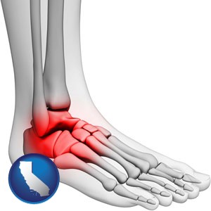 a foot and ankle, showing the inflamed area in red - with California icon