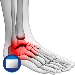 a foot and ankle, showing the inflamed area in red - with Colorado icon