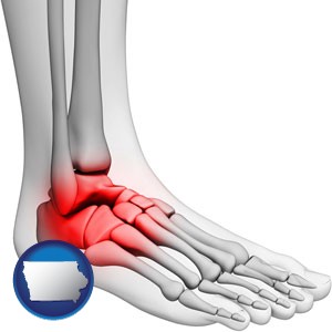 a foot and ankle, showing the inflamed area in red - with Iowa icon