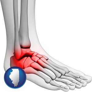 a foot and ankle, showing the inflamed area in red - with Illinois icon