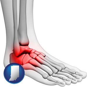 a foot and ankle, showing the inflamed area in red - with Indiana icon