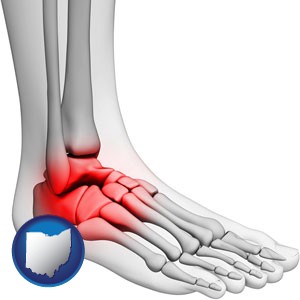 a foot and ankle, showing the inflamed area in red - with Ohio icon