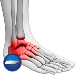 a foot and ankle, showing the inflamed area in red - with Tennessee icon